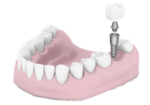 implants